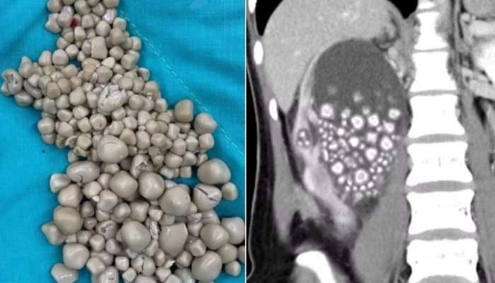 300 gallstones removed from Taiwanese woman's body;